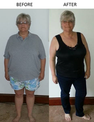 Bariatric Patient Travels To Mexico For Gastric Sleeve Surgery With ...